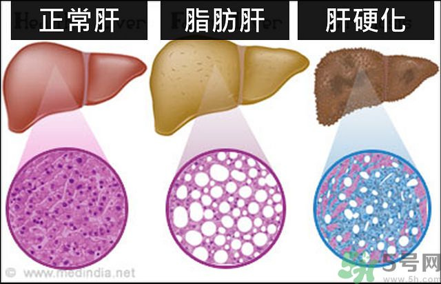 得了脂肪肝該怎么治？脂肪肝對人體危害有多大？