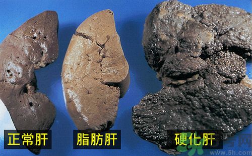 得了脂肪肝該怎么治？脂肪肝對人體危害有多大？