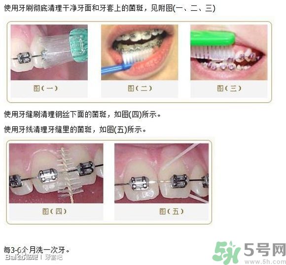 18歲還能戴牙套嗎？戴牙套真的能瘦臉改變臉型嗎？