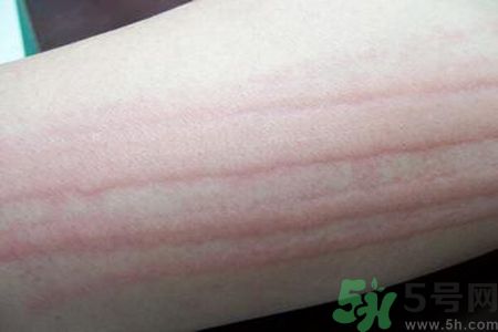 蕁麻疹會不會傳染？蕁麻疹怎么治才能好？