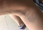 40歲女性小腿靜脈曲張怎么辦？