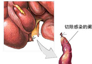 闌尾手術(shù)會(huì)影響結(jié)腸嗎？闌尾手術(shù)術(shù)后要注意什么？