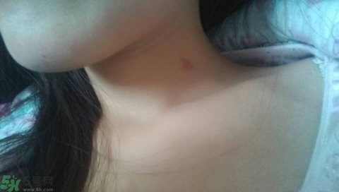 種草莓吻痕是什么意思？吻痕是怎么弄出來的？