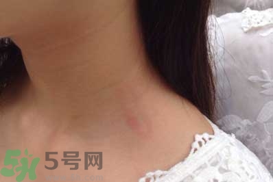 種草莓吻痕是什么意思？吻痕是怎么弄出來的？