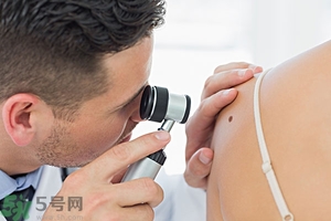 臉上長(zhǎng)痣是什么原因？臉上為什么會(huì)長(zhǎng)痣？