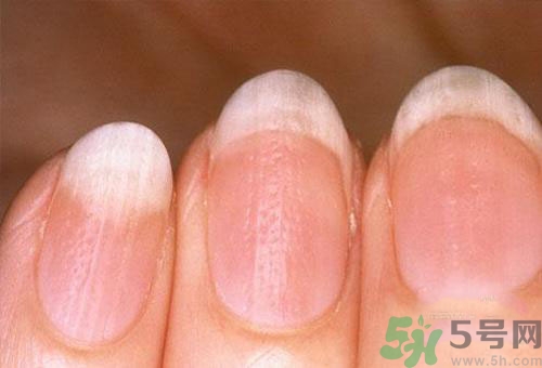 指甲發(fā)白是怎么回事？指甲發(fā)白代表什么？