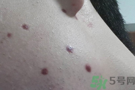 激光點(diǎn)痣后可以洗臉嗎？激光點(diǎn)痣后需要注意什么？