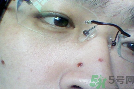 激光點痣后可以洗臉嗎？激光點痣后需要注意什么？