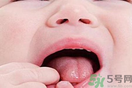 寶寶口腔潰瘍怎么辦？治療寶寶口腔潰瘍方法有什么？