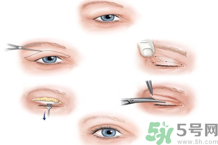 割雙眼皮分哪幾種？割雙眼皮需要多少錢？