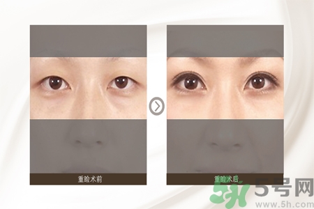 割雙眼皮分哪幾種？割雙眼皮需要多少錢？