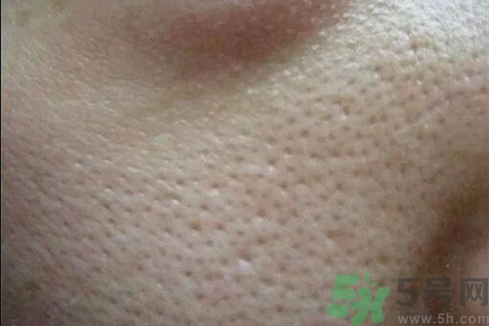 皮膚毛孔粗大原因有哪些？如何預(yù)防皮膚毛孔粗大？