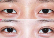 割雙眼皮分哪幾種？割雙眼皮需要多少錢？