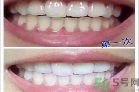 冷光美白牙齒的價(jià)格是多少？做冷光美白牙齒需要多少錢(qián)？