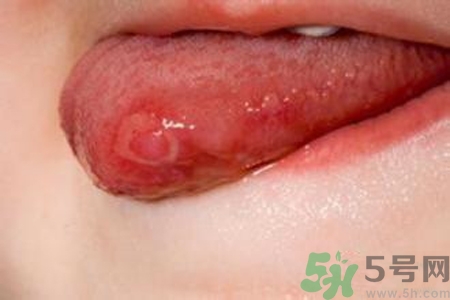 舌頭長泡怎么辦？舌頭長泡的原因？
