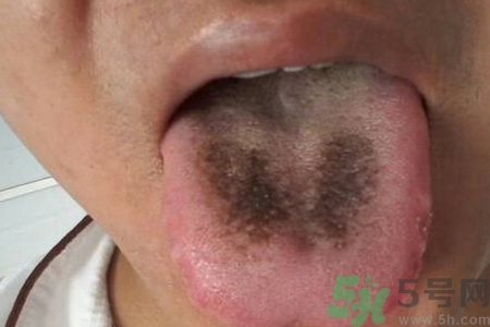 舌頭發(fā)黑怎么回事？舌頭發(fā)黑怎么辦？