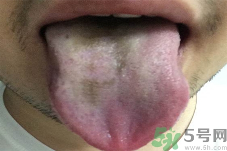 舌頭發(fā)黑怎么回事？舌頭發(fā)黑怎么辦？