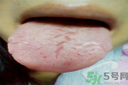 舌頭上有裂紋是怎么辦？舌頭上有裂紋是什么原因？