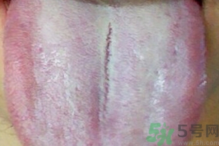 舌頭發(fā)白是什么原因？舌苔發(fā)白是怎么辦？