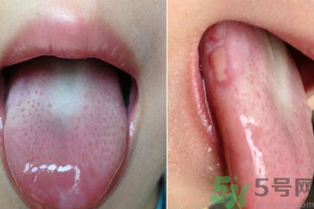舌頭潰瘍怎么辦？舌頭潰瘍的原因？