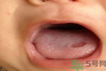 舌頭潰瘍怎么辦？舌頭潰瘍的原因？