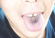 舌頭發(fā)黑怎么回事？舌頭發(fā)黑怎么辦？