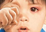 寶寶得了紅眼病怎么辦？寶寶得了紅眼病怎么治？