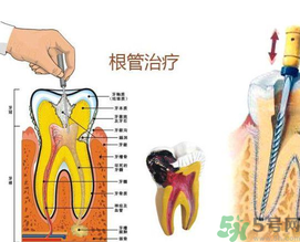什么是根管治療？為什么牙齒疼要做根管治療？