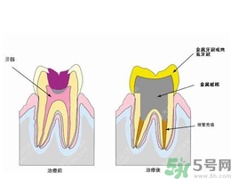 什么是根管治療？為什么牙齒疼要做根管治療？