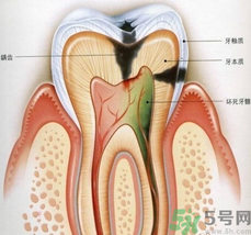 什么是根管治療？為什么牙齒疼要做根管治療？