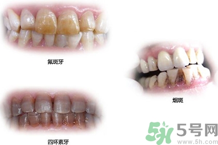 四環(huán)素牙是什么？四環(huán)素牙是怎么形成的？
