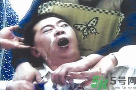 癲癇的典型癥狀有哪些？癲癇是什么？