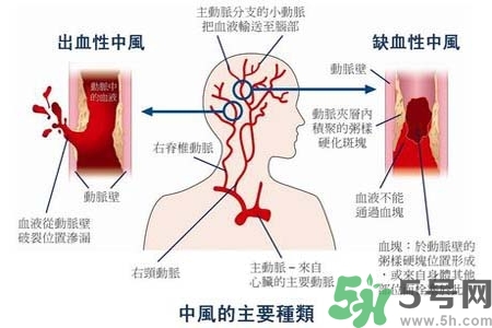 腦中風(fēng)是什么？腦中風(fēng)的癥狀？