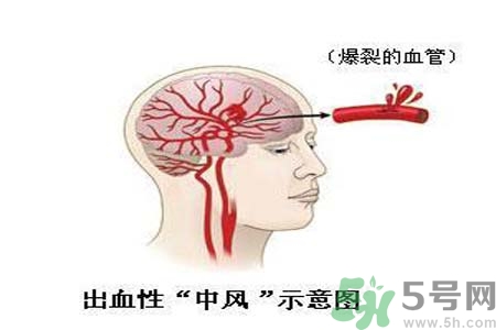 腦中風的護理措施？腦中風的飲食護理？