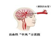 腦中風(fēng)的發(fā)病因素？腦中風(fēng)的并發(fā)癥有哪些 ？