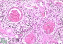 慢性腎炎能治好嗎？慢性腎炎能活多久？