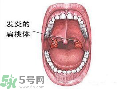 慢性咽炎是什么？慢性咽炎的癥狀有哪些？