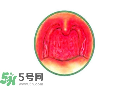 慢性咽炎的治療方法？慢性咽炎的藥物治療？