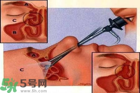 鼻竇炎的高發(fā)人群？如何預(yù)防鼻竇炎？