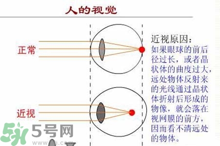 近視眼的發(fā)病因素？近視眼的并發(fā)癥有哪些？