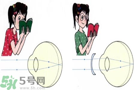 近視眼的發(fā)病因素？近視眼的并發(fā)癥有哪些？