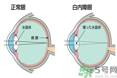 白內(nèi)障的發(fā)病因素是什么？白內(nèi)障并發(fā)癥有哪些？