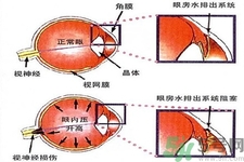 青光眼的發(fā)病因素是什么？青光眼的并發(fā)癥有哪些？