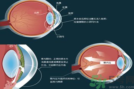 青光眼的高發(fā)人群有哪些？如何預(yù)防青光眼？