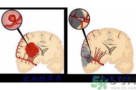腦出血的發(fā)病因素是什么？腦出血的并發(fā)癥有哪些？