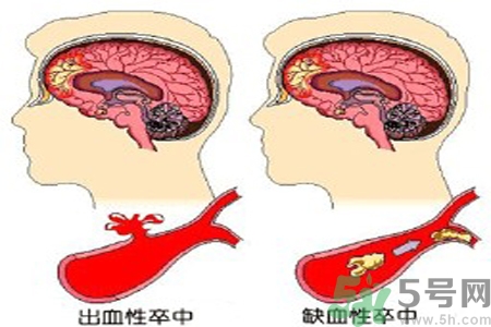 腦出血的治療方法是什么？腦出血可以用哪些藥物治療？