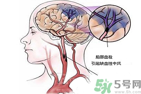 腦出血的治療方法是什么？腦出血可以用哪些藥物治療？