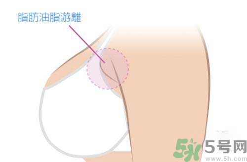 副乳是什么？副乳的危害