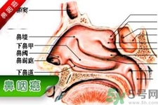 鼻咽癌的發(fā)病因素是什么？鼻咽癌的并發(fā)癥有哪些？
