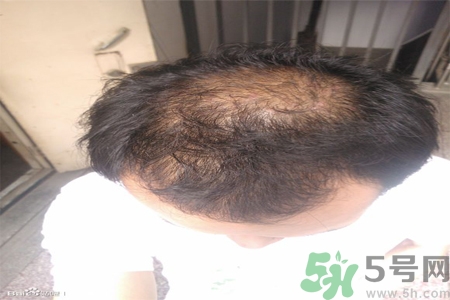 脫發(fā)的措施有什么？脫發(fā)的注意飲食有哪些？